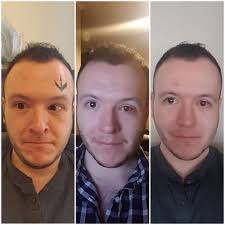 I am going to go over with you 2 exercises that you guys need to do if you want. This Man S Photos Capture How Lazy Eye Surgery Changed His Life Health Com
