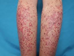 Image result for systemic lupus erythematosus