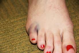 Like a shoe that's too tight. Broken Toes Podiatry Associates P C