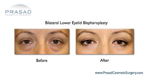 eye bag surgery with fast recovery