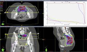 reirradiation for rectal cancer using