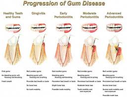 Progression Of Gum Disease Chart Gum Disease Treatment