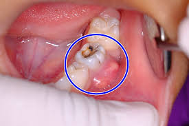 tooth abscess symptoms causes and