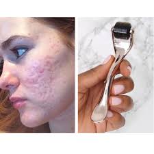 dermarolling for scars and acne
