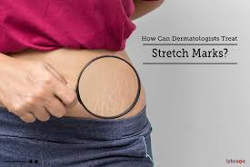 dermatologists treat stretch marks