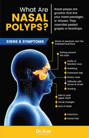 nasal polyps 19 natural treatments