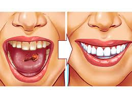 get rid of tartar in teeth naturally
