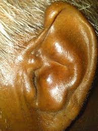 Nates a warrior and get the most respect. Cauliflower Ear Identification Treatment And More