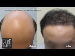 We feel the ultimate way to be great at something is to focus on it. Los Angeles Best Fue Hair Transplant
