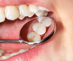 But, if the extraction of the teeth caused much damage to the gum tissues, the bleeding might stay for long. How Long Do You Have To Wear Gauze After A Tooth Extraction