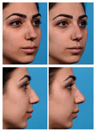 What is needed to prepare for filler injections. Liquid Rhinoplasty Before And After Pictures