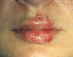 cold sores herpes simplex virus photograph