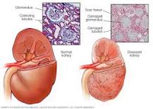 Chronic kidney disease - Symptoms and causes - Mayo Clinic