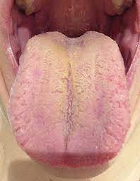 furry tongue dry mouth r tcm