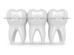 Meet the organization's financial guidelines, which vary by state. Adult Braces Types Costs Benefits Newmouth
