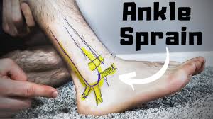 can you run with a sprained ankle