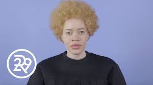 this model was born with albinism get