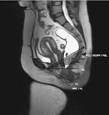 pelvic organ prolapse