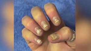 gel nail polish as allergic reactions