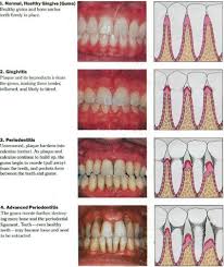 gum disease treatment rochester ny