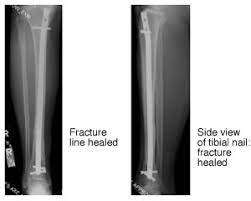 understanding your intramedullary nail