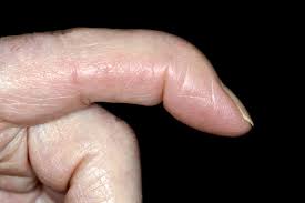 mallet finger nhs