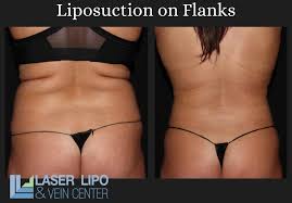 liposuction in st louis an