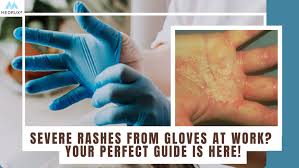 severe rashes from gloves at work your