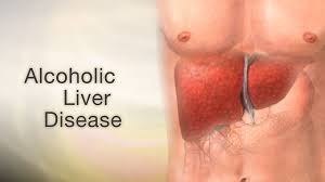 alcoholic liver disease information