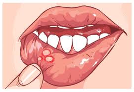 mouth sores and cancer treatment fv
