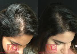 minoxidil for hair loss treatment