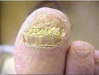 toenail disorders l newport ri l