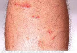 Rashes can be painful or itchy and lead to blisters and raw skin, in some cases. Poison Ivy Rash Symptoms And Causes Mayo Clinic