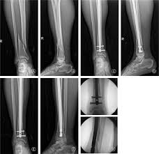 distal tibial fractures