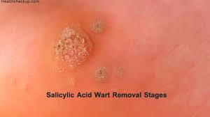 Your doctor cuts away the wart or destroys it by using an electric needle (electrodesiccation and curettage). Stages Of Wart Removal Using Salicylic Acid By Dr Ahmed
