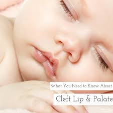 cleft lip and palate here s what you
