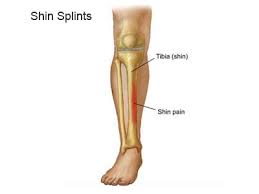 anterior shin splint