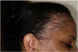 vitamin b12 deficiency cause hair loss