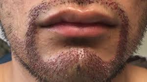 When i went back on testosterone, all of my body and facial hair very quickly grew back. Facial Hair Restoration Dallas Facial Hair Transplant Plano Tx