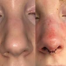 rhinoplasty nosejob recovery and what
