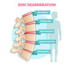 bulging disc be treated through surgery