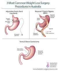 Weight Loss Surgery Australia All You Need To Know