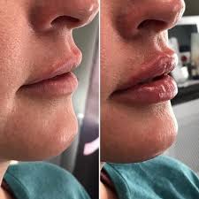 our new lip filler restylane kysse