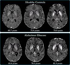 brain iron aculation linked to