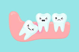 wisdom tooth pain symptoms causes