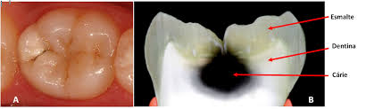 La carie dentaire est une infection de la dent. Portail De L Ufrn