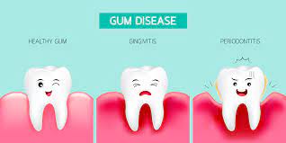 gingivitis inflammation of the gums