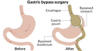tunisia gastric byp surgery