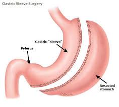 gastric sleeve and sleeve revision
