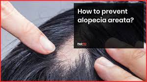 alopecia areata food t home